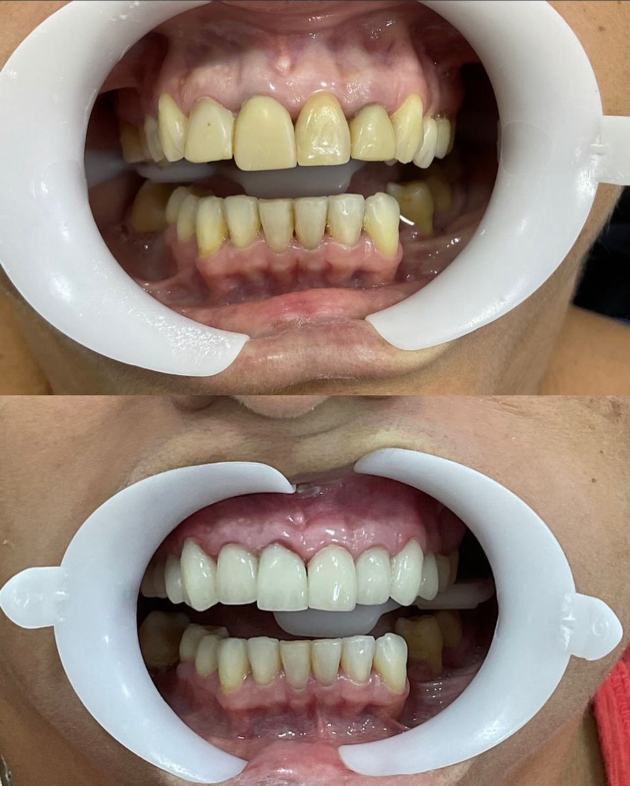 Clareamento Dental - Depois