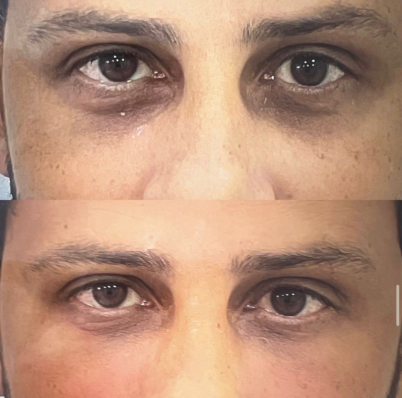 Redução de Olheiras - Resultado