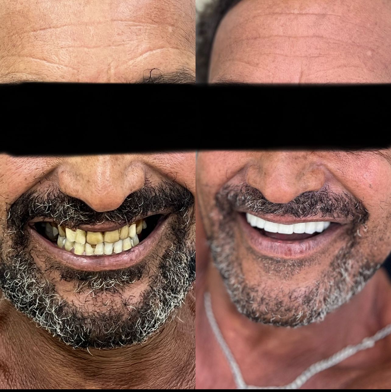 Sorriso - Depois